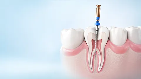 Endodontia (Tratamento de Canal)