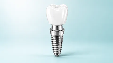 Implante Dentário