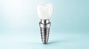 Implante Dentário